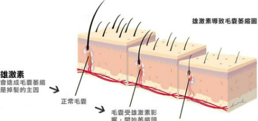 什么是雄性激素性脱发