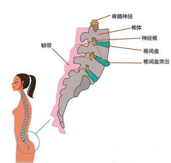 腰椎间盘突出的最佳治疗方法是什么？