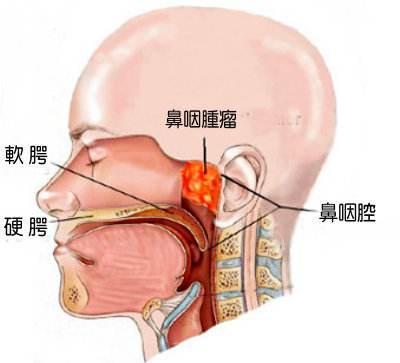 咽喉癌早期症状是什么？