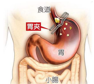 什么是减重手术？