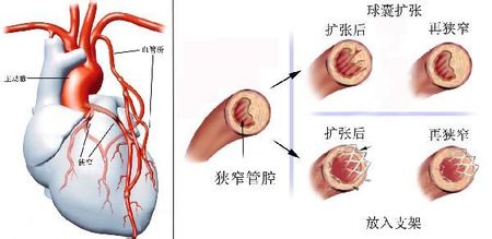 心脏搭桥和支架有什么不同