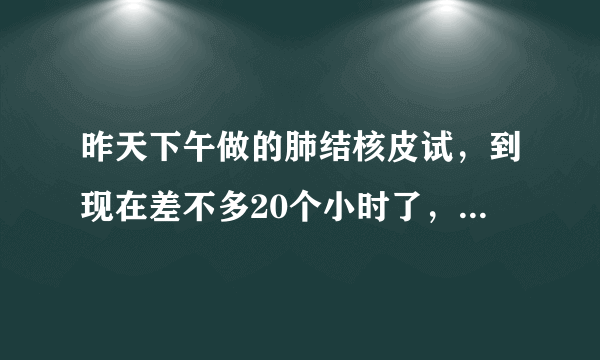 昨天下午做的肺结核皮试，到现在差不多20个小时了，出现图片中的红肿现象，有专业人士回答一下吗？请问